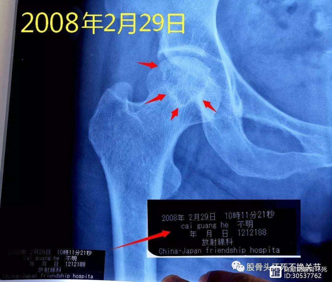 遂宁人工骨头医保报销多少(人工骨头医保报销多少比例)
